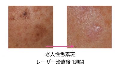 老人性色素斑（コメントあり）